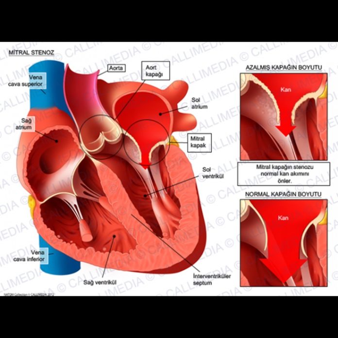 mitral_stenoz