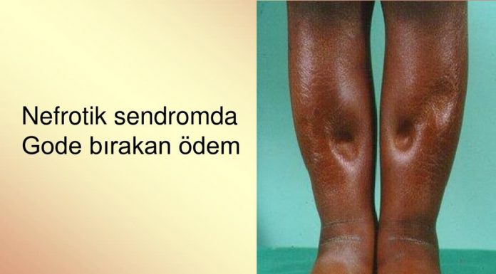 Nefrotik Sendrom