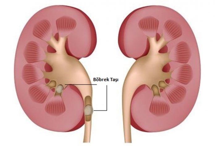 Böbrek Taşı