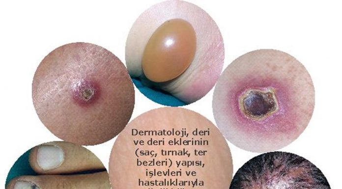 Deri ve Zührevi Hastalıklar