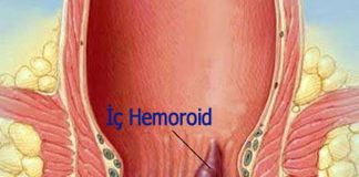 Hemoroid Hastalığında Tanı Nasıl Konulur?