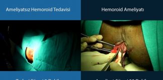 Klasik Hemoroid Ameliyatı (Hemoroidektomi) Nedir?