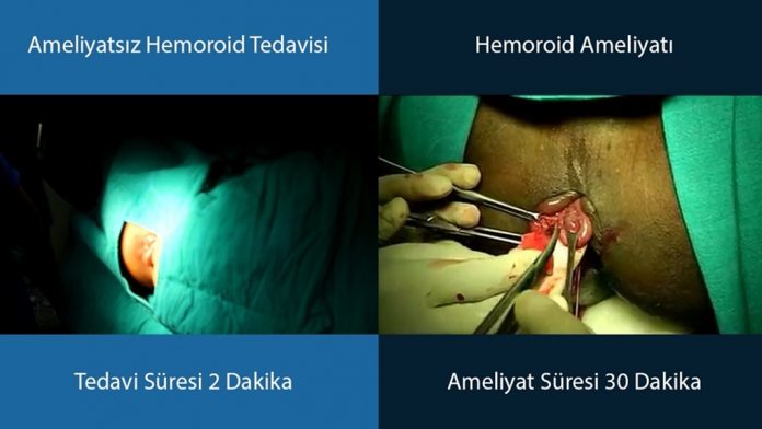 Hemoroid